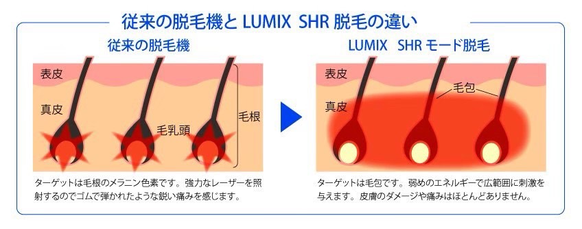 茨城県龍ヶ崎・牛久 脱毛 脱毛専門サロンmiumiu （ミュウミュウ）miu miuの脱毛はここがすごい！