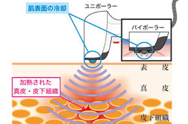 龍ヶ崎・牛久の脱毛・痩身・エステなら優貴（ゆうき）サーモシェイプの効果イメージイラスト